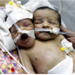 Parents Left To Choose Which Of Their Conjoined Twins Will Survive (Photos)