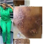 Lady Cries Out Bitterly After Butt Surgery Goes Wrong, Reveals Nigerian Doctor Gave Her Infection (photos)